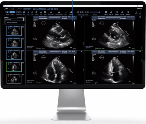 When integrated with InView, Ascend’s high-performance zero-footprint Cardiovascular viewer, Us2.ai’s FDA-cleared and CE Marked echocardiogram algorithms automate measurements and pre-populate structured report templates. 