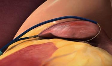 In the LAAOS III trial, surgeons could seal off the LAA during the open heart procedure using sutures, staples or approved closure devices. The image shows a SentraHeart lasso type LAA occluder about to seal off the LAA from the outside of the heart.  #ACC21 #ACC2021