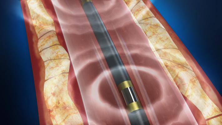 Lithotripsy Safe and Effective in Calcified Stenotic Peripheral Arteries
