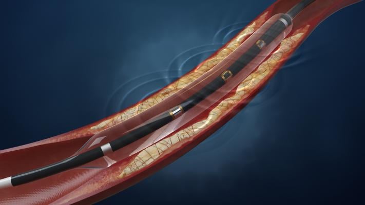 Shockwave Launches Coronary Intravascular Lithotripsy in Europe
