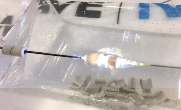 The Shockwave intravascular lithotripsy system produces a flash of light as it releases a sonic shockwave, as seen here as it is about to shatter a gypsum bead during a TCT 2019 demonstration at the vendor's booth. The technology combines a miniaturized lithotripsy system with a low-pressure balloon catheter to expand peripheral or coronary arteries without causing vessel trauma. Photo by Dave Fornell