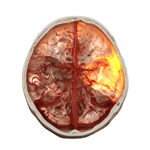 Siemens Healthineers Receives ARPA-H Funding to Develop Remote Endovascular Robotics