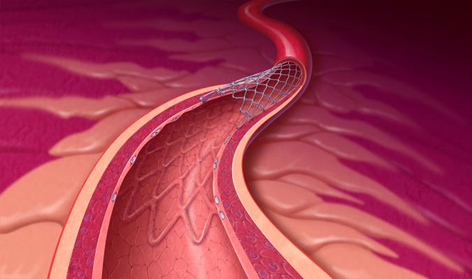 Improved Radiation Technique Offers Treatment for In-stent Restenosis | DAIC