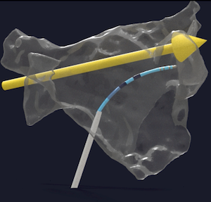 Stereotaxis Finalizes Robocath Acquisition