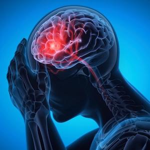 New Research Links Increased Stroke Risk to Cancer Diagnosis