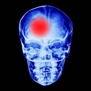 Rapid Response Teams Expedite Imaging, Treatment for Acute Stroke Patients