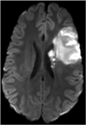 stroke damage, MRI, contrast agent, gelatinase, University of Missouri study