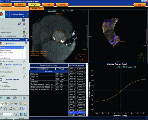 First-Ever Risk Tool Helps Predict TAVR Readmission Rates in 2018 SCAI late-breaking study. #SCAI, #SCAI2018