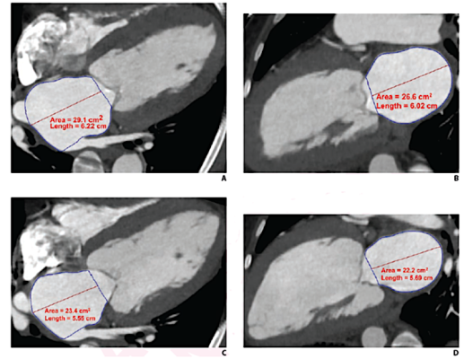 Cardiac CTA derived left atrium emptying fraction (LAEF) improves predictive performance of established clinical risk scores and may be used to assess TAVR patient risk during pre-procedure workup and post-procedural surveillance. These images show LAVmax (A and B), LAVmin (C and D), and LAEF using cardiac CTA. LAEF was calculated as (LAVmax-LAVmin)/LAVmax x 100. Given LAVmax of 109 mL and LAVmin of 80 mL, the LAEF was calculated to be 27%.  Image courtesy of AJR.