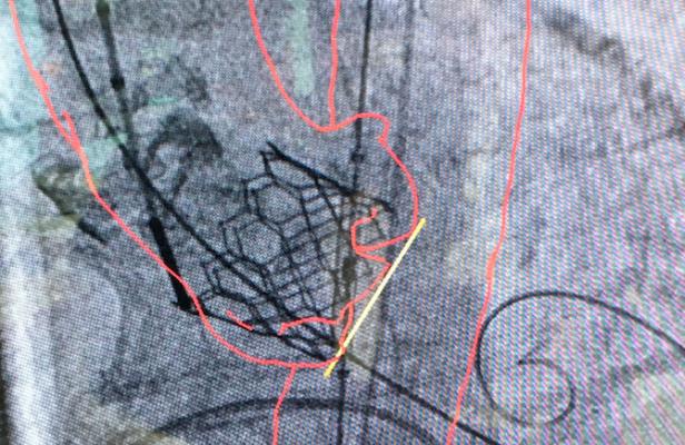 A Sapien 3 TAVR valve in position as seen under GE Assist guidance on angiography. Study Finds Sustained Benefit for TAVR vs. SAVR at One Year. #TCT2019 #TCT19