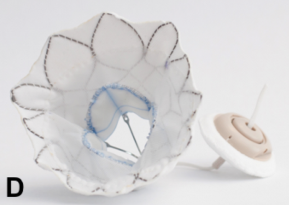 Tendyne Transcatheter Mitral Valve Replacement Device Demonstrates Positive 30-Day Outcomes