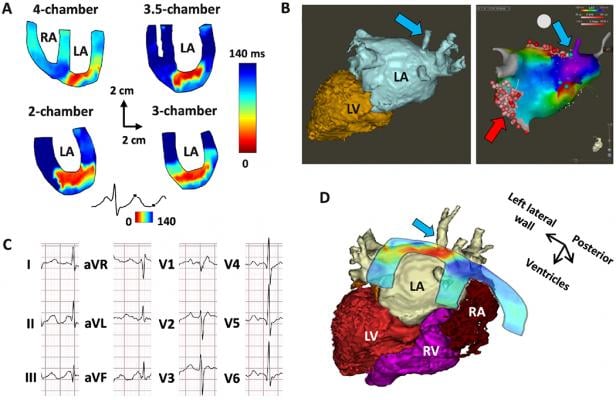 Top left, electromechanical wave imaging (EWI) isochrone renderings showing the activation points of the myocardium based on echocardiography axial strain measurements. Bottom right, EWI images overlaid on patient's CT scan of the heart.