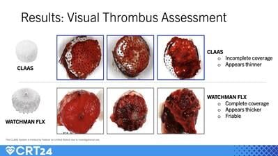 Visual Thrombus Assessment as presented by Dr. William Gray at the Cardiovascular Research Technologies (CRT) 2024 conference.