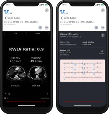Screen shots of Viz PE with RV/LV ratio data (left), along with the company’s ECG Viewer (right). Both are part of the comprehensive Viz Cardio Suite designed to speed and improve patient access to innovative cardiovascular treatments. Source: Viz.ai.