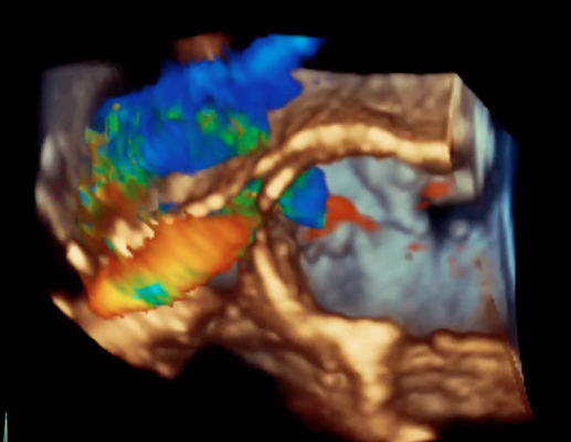 An example of one of the latest echocardiography image processing technologies, GE's Vmax.