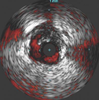 IVUS Demonstrates Greater Visualization of Dissections in iDissection Classification Study