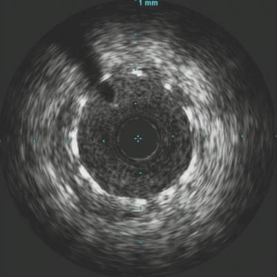 Philips Healthcare, Volcano IVUS showing an implanted stent. IVUS might offer an alternative to contrast angiography in patients with acute kidney disease (AKD).