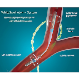 WhiteSwell Announces Trial Results Related to the DELTA-HF Study in Acute Decompensated Heart Failure