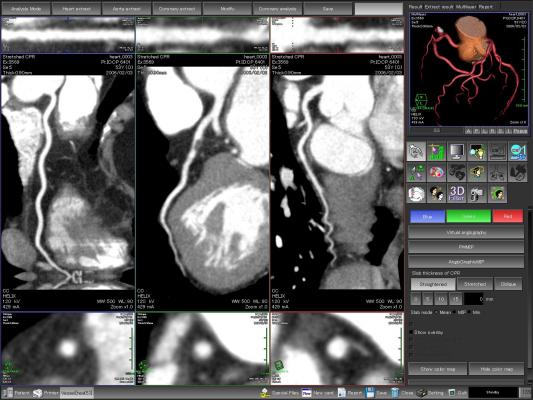 coronary CT angiography, CCTA, alcohol consumption, CAD, coronary artery disease, RSNA 2016