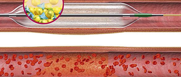 Primus Drug-Eluting Balloon Balloon Catheters Peripheral Artery Disease devices