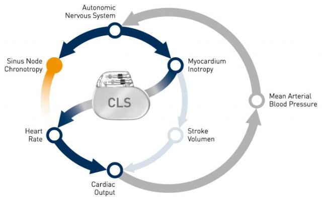 Biotronik, CLS, B3 clinical trial, atrial fibrillation, AF patients, stroke risk