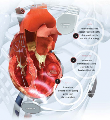 Cardiac Resynchronization Therapy Devices (CRT)