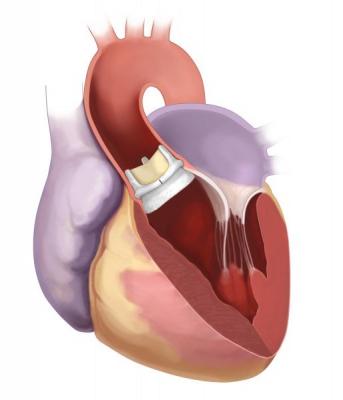 Northwestern Medicine, Edwards Lifesciences, Intuity Elite suturless aortic valve, first in Illinois