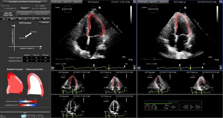 Strain Imaging Improves Cardiac Surveillance of Certain Breast Cancer Patients