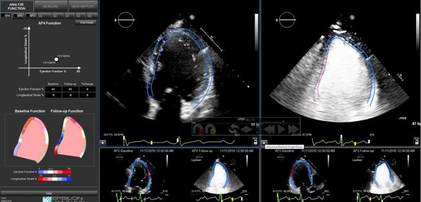 Epsilon Imaging Echo insight (echoinsight) strain imaging on cardiac ultrasound