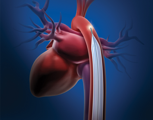 Diversen vrouw teller Intra-Aortic Balloon Therapy Aids Cardiogenic Shock Patients | DAIC