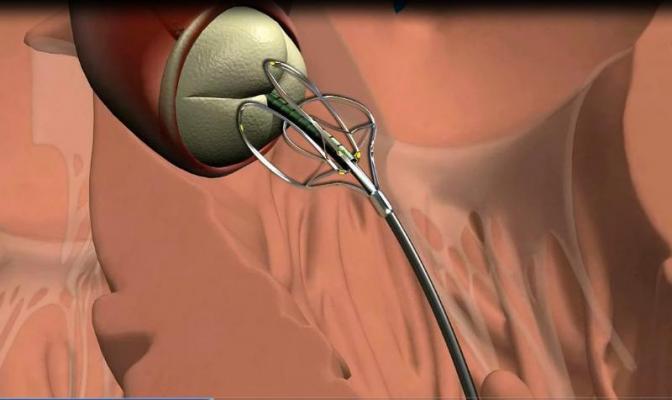 cath lab guidewires heart valve repair medivalve acwire guidewire