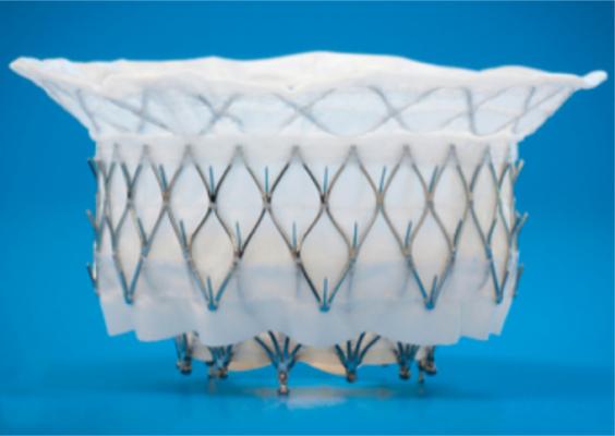 The Medtronic Intrepid transcatheter mitral valve replacement (TMVR) system is being tested in the APOLLO Trial. 