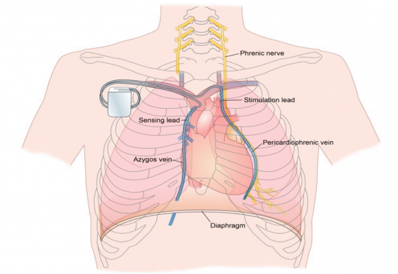 The Respicardia Remede System is a pacemaker-like device designed to improve cardiovascular health by restoring natural breathing during sleep in patients with Central sleep apnea.