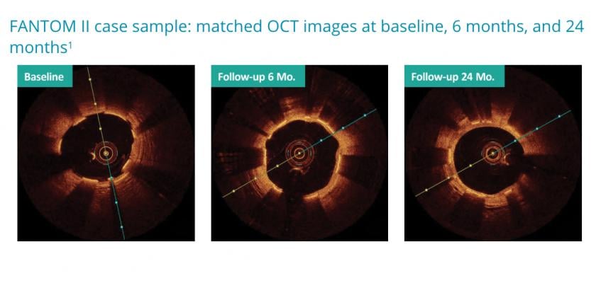 OCT images showing neointimal strut coverage on the Reva Fantom bioresorbable stent from a FANTOM II trial case sample. It shows matched OCT images at baseline, six months and 24 months. #TCT #TCT2018 #TCT18 #BRS #bioresorbablestents #bioresorbablescaffolds