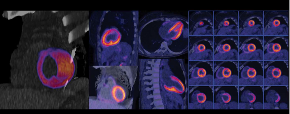 Nuclear myocardial perfusion scan performed on a Biograph Vision positron emission tomography/computed tomography (PET-CT) system from Siemens Healthineers. The image shows good clarity with delineation of the left ventricular edge and papillary muscles without cardiac gating.