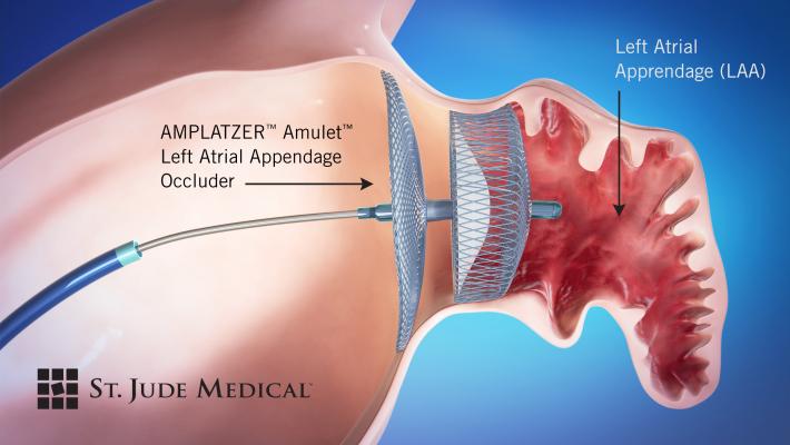 The U.S. Food and Drug Administration (FDA) has approved a the CATALYST trial designed to assess Abbott's Amplatzer Amulet left atrial appendage (LAA) occluder for people with atrial fibrillation (AF or AFib). 