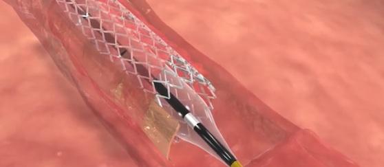 Stentys, commercialization, BTK stent, below-the-knee arteries