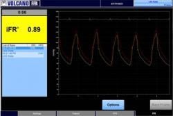 iFR Scout, pullback software, iFR Modality, fractional flow reserve, FFR