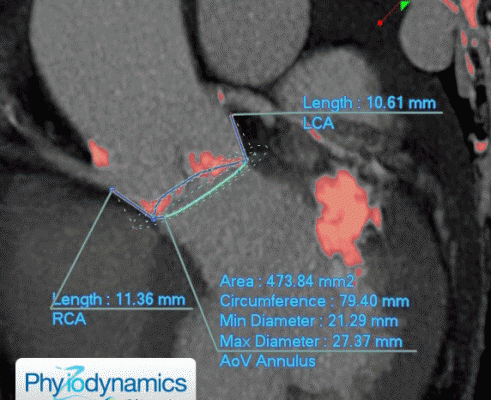 Ziosoft's PhyZiodynamics showing calcium in the aortic root