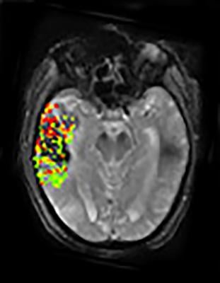 DEFUSE-2 study, MRI, brain bleeding risk, post-stroke treatment, NIH