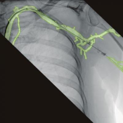 An example of the 3-D vascular roadmapping technology on the Ziehm mobile C-arm systems.