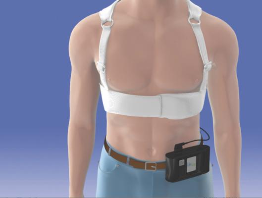 The Zoll Lifevest Wearable External Defibrillator Offers a Bridge Therapy and buys time for physicians to determine if an implantable defibrillator is needed. 
