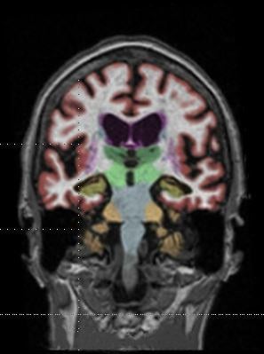Gadolinium contrast agents (GBCAs) are partly retained in the brain, raising safety concerns, as seen in this MRI.