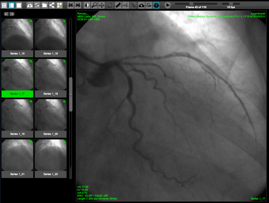 WebPAX, Heart Imaging Technologies, PACS, Cardiac PACS, Echo Imaging