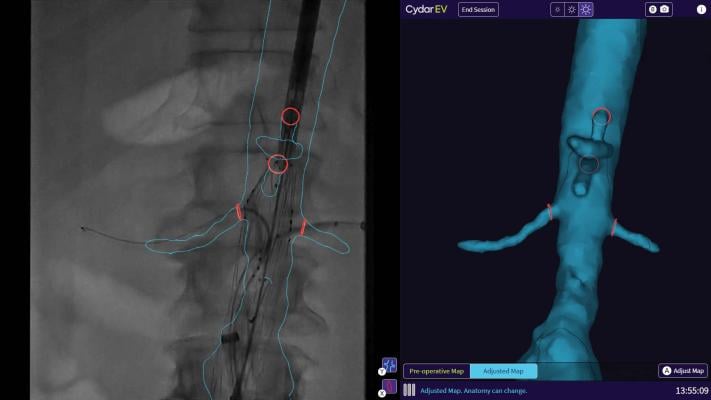 Cydar EV Maps assists in the planning, real-time guidance, and post-procedure review of endovascular surgery. It brings cloud-based AI and computer vision to mobile surgery, enabling reductions in radiation exposure, fluoroscopy time, and procedure time.