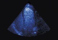 Lantheus Medical Imagings Definity perflutren lipid microsphere ultrasound contrast agent