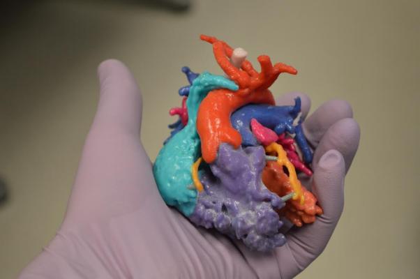 A 3-D printed anatomical model of a patient's heart with congenital heart disease. Models like this give cardiac surgeons a three-dimensional model of the complex anatomy so they can plan procedures ahead of the surgery date, consult with other physicians and use the model to navigate the anatomy during surgery. 3D printing, heart