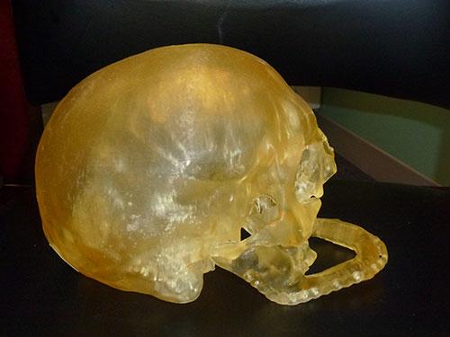 A 3-D model of a patient's skull to help guide planning of a full facial reconstruction., face transplant, 3d printing