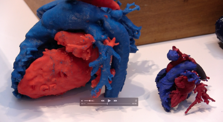 A 3-D printed congenital heart model of a pediatric patient with coaptation of the great vessels, showing both the actual sized heart and the ability of 3-D printing to upsize the image to a larger model so it is easier to understand the anatomy. These models were created by the University of Minnesota Visible Heart Lab and was on display at ACC.16. University of Minnesota Visible Heart lab
