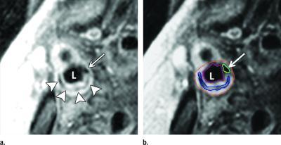 Carotid Artery MRI Systems Clinical Study Trial Cath Lab Cardiac Diagnostics